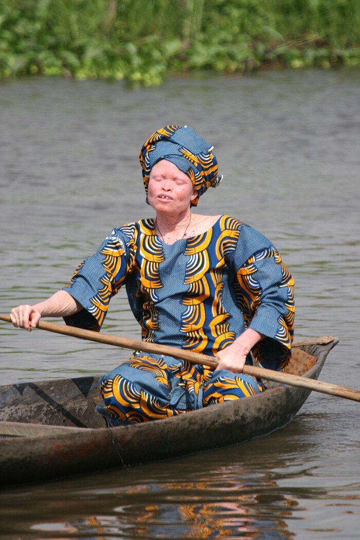 Albino-Frau in Benin